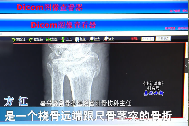 97歲高齡老人，傳統(tǒng)復(fù)位免于手術(shù)3.png